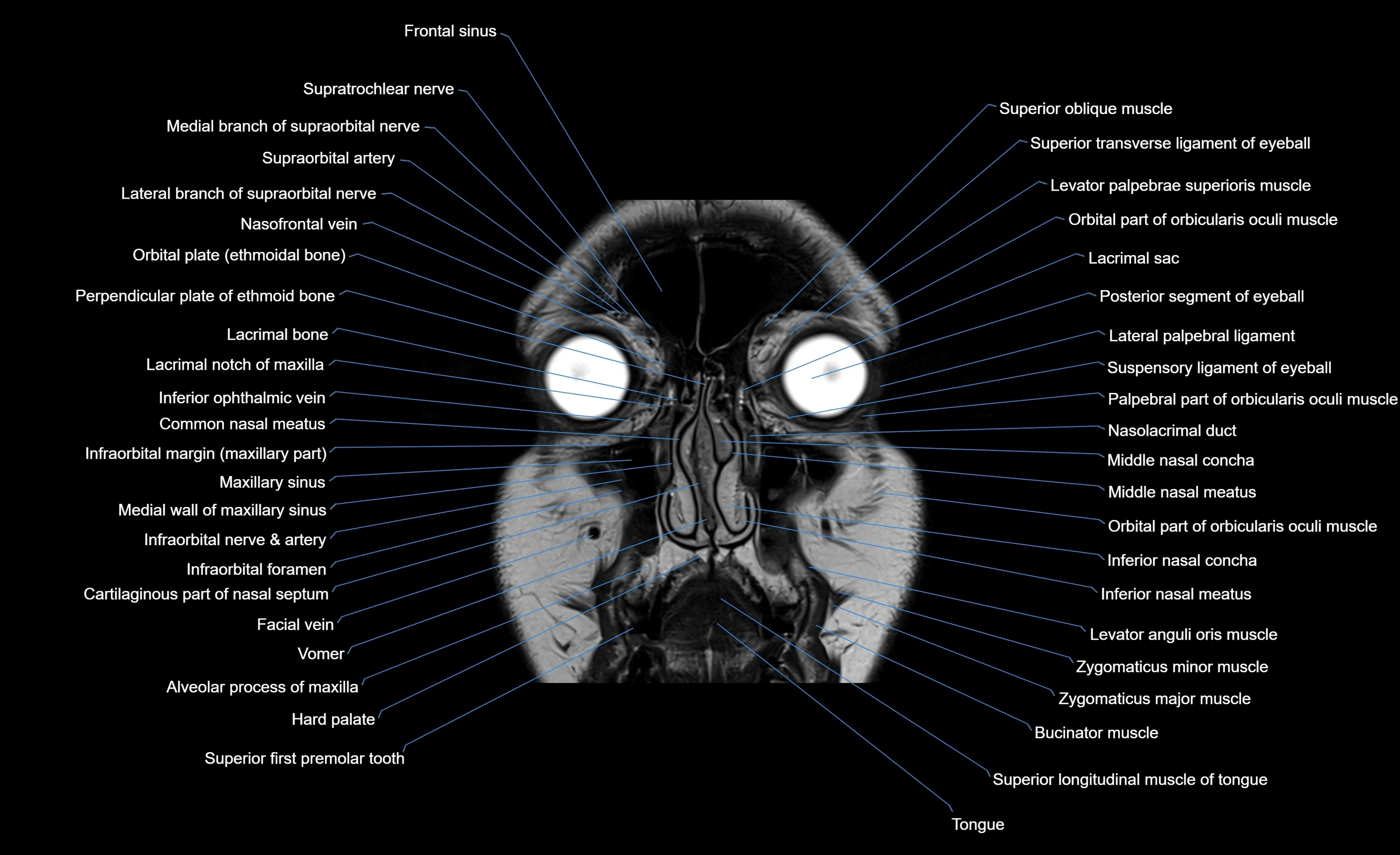 MRI face & paranasal sinuses(PNS) labelled  coronal  cross sectional anatomy 3T radiology  image-img-00001-00015.webp